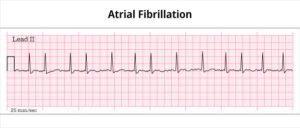 Fibrilação atrial